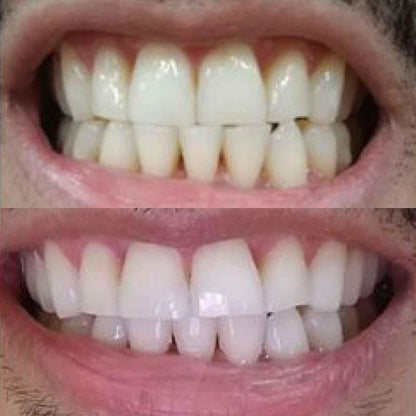 Pasta de Dientes Blanqueadora con Nano-Hidroxiapatita - Medikal Care